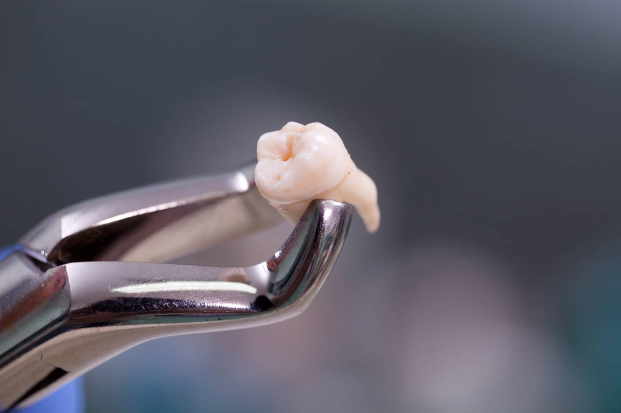 What to Expect After Wisdom Tooth Removal